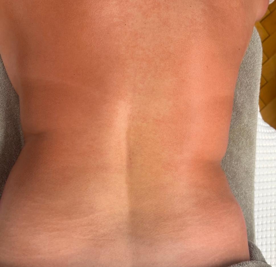 Rücken und Taille einer Kundin nach der ersten brasilianischen Lymphdrainage