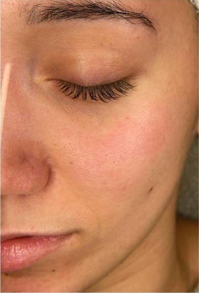 Wange einer Kundin nach sechs Microneedling-Behandlungen