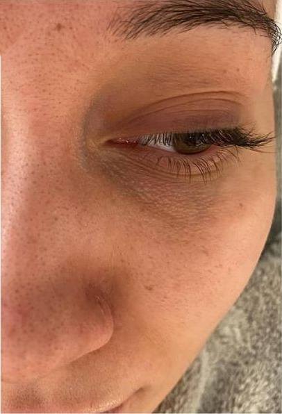 Wange und Augenpartie einer Kundin vor dem Microneedling