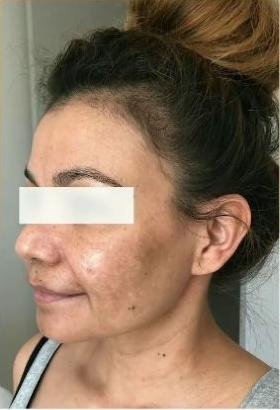 Gesicht einer Kundin mit Pigmentflecken vor dem chemischen Peeling