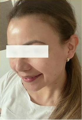 Gesicht derselben Kundin nach acht chemischen Peelings